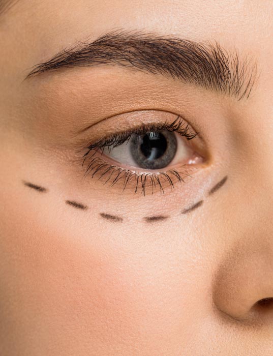 göz kapağı ameliyatı